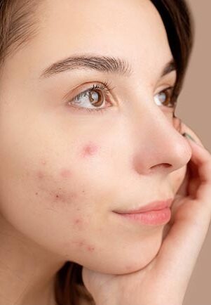 Comedonal Acne