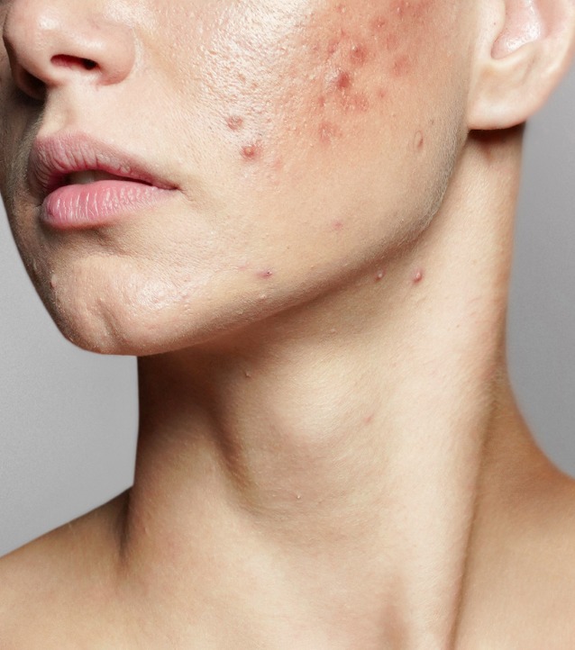 Sever Nodular Acne